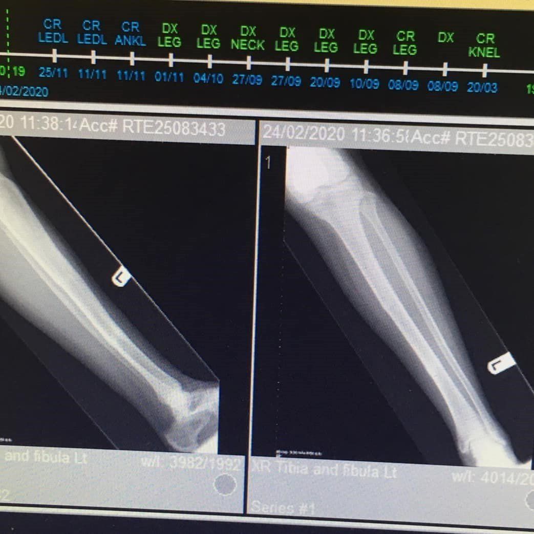 tib/fib fracture xrays