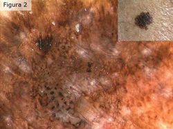 Dermoscopia Dermoscopia
