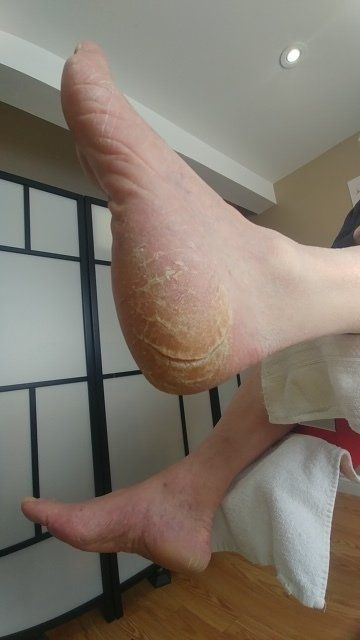 Dry cracked feet, cracked heels