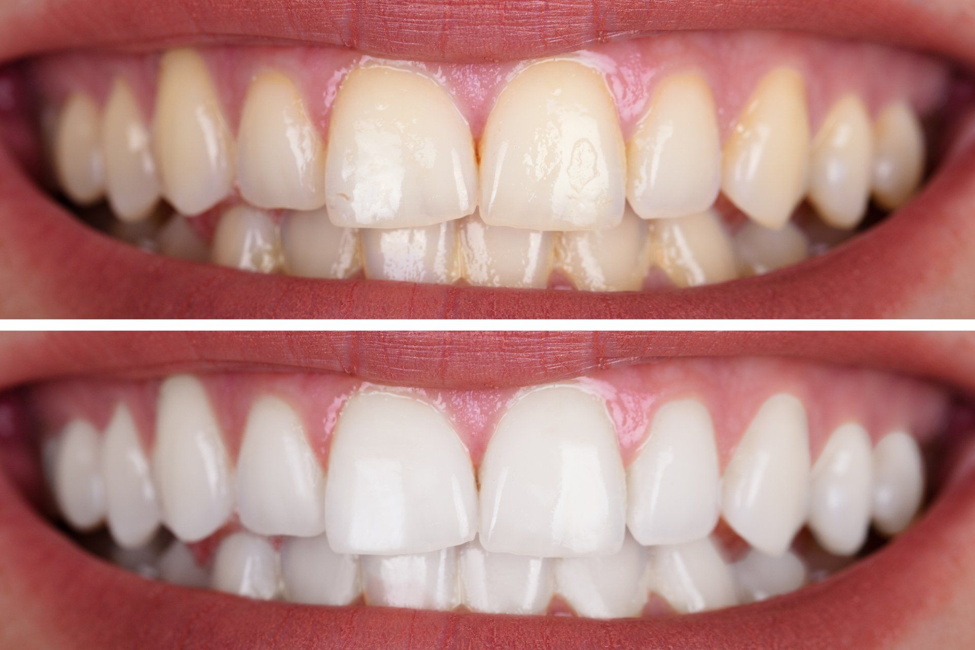 Woman's Teeth Before And After Whitening - Dental Treatments in Port Macquarie, NSW Woman's Teeth Before And After Whitening - Dental Treatments in Port Macquarie, NSW