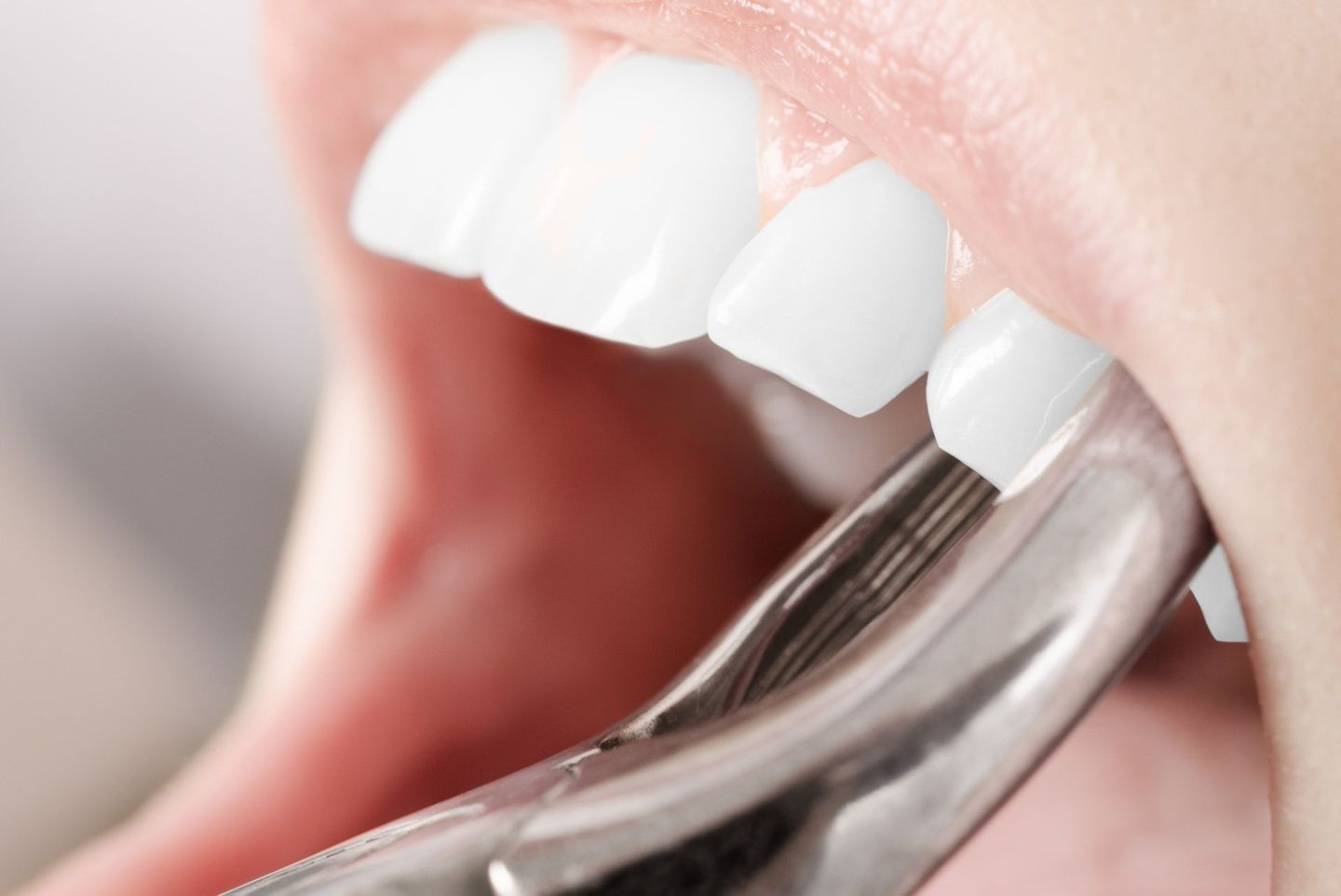 Extracting The Tooth Close Up - Dental Treatments in Port Macquarie, NSW Extracting The Tooth Close Up - Dental Treatments in Port Macquarie, NSW