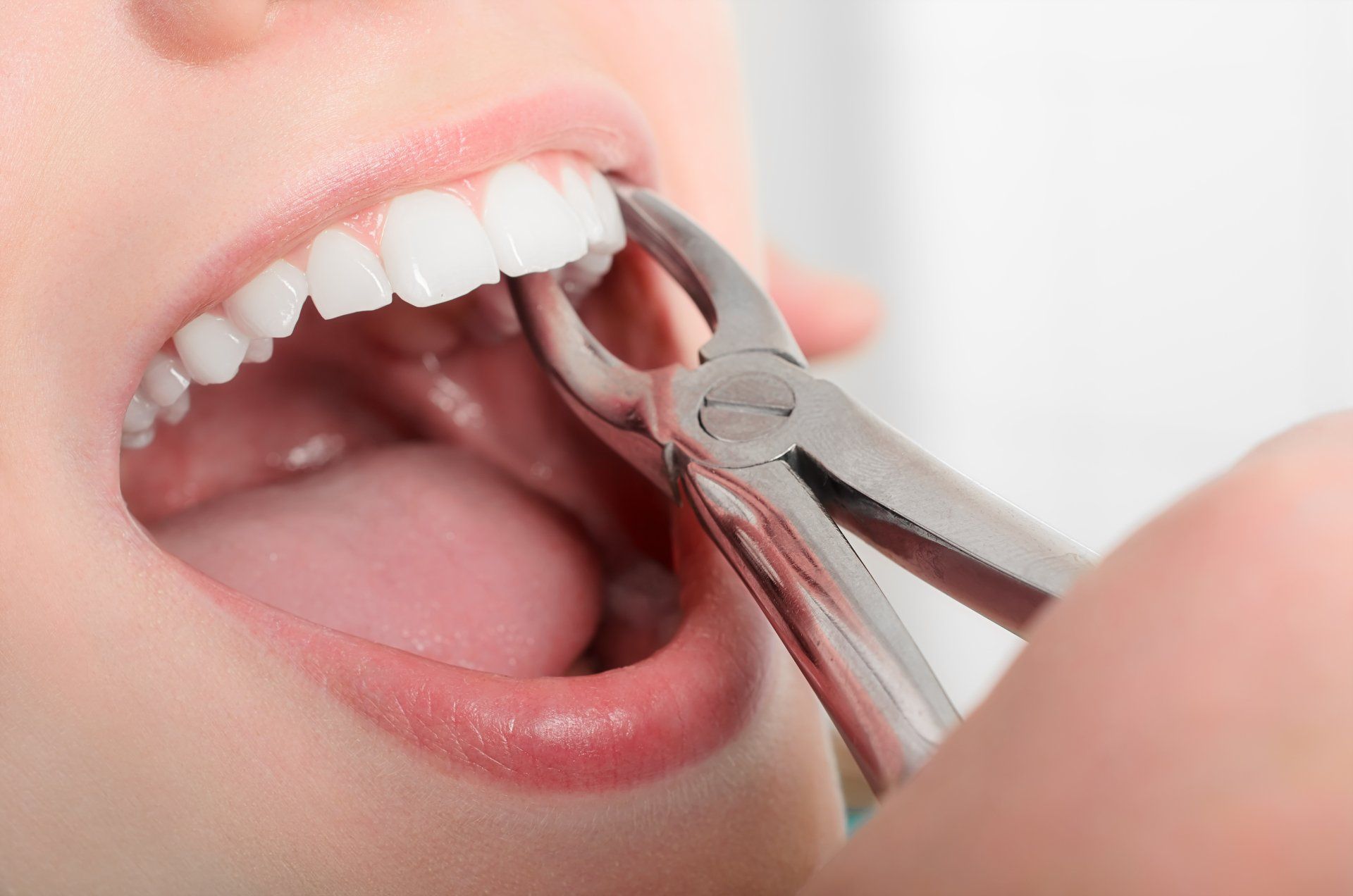 Removing The Sick Tooth From Girls Mouth - Dental Treatments in Port Macquarie, NSW