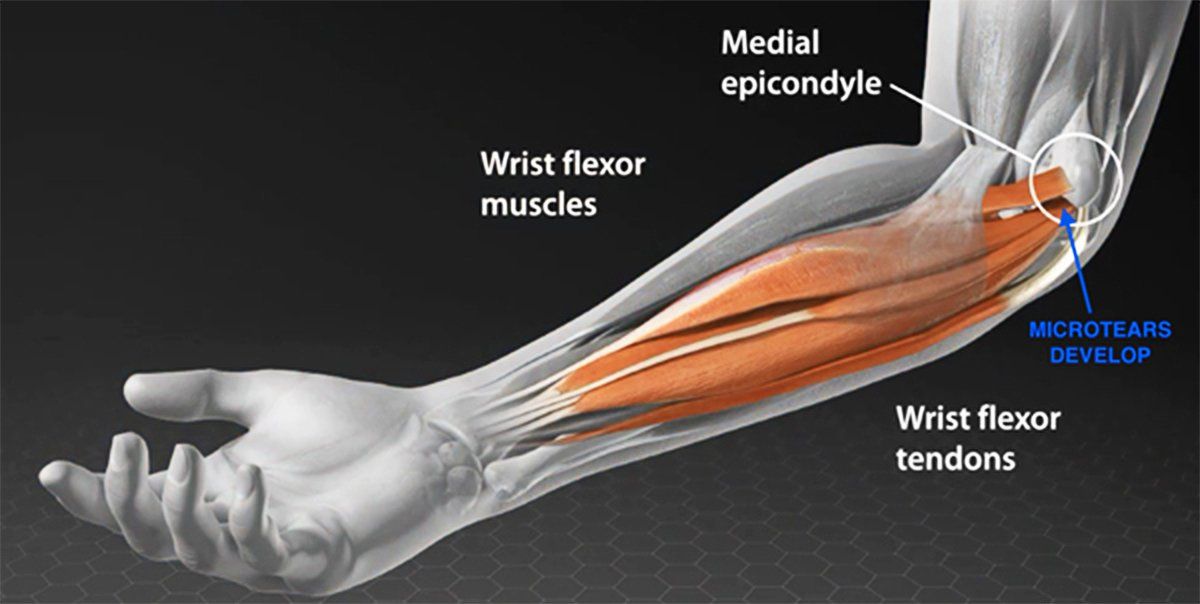 Golfer's Elbow
