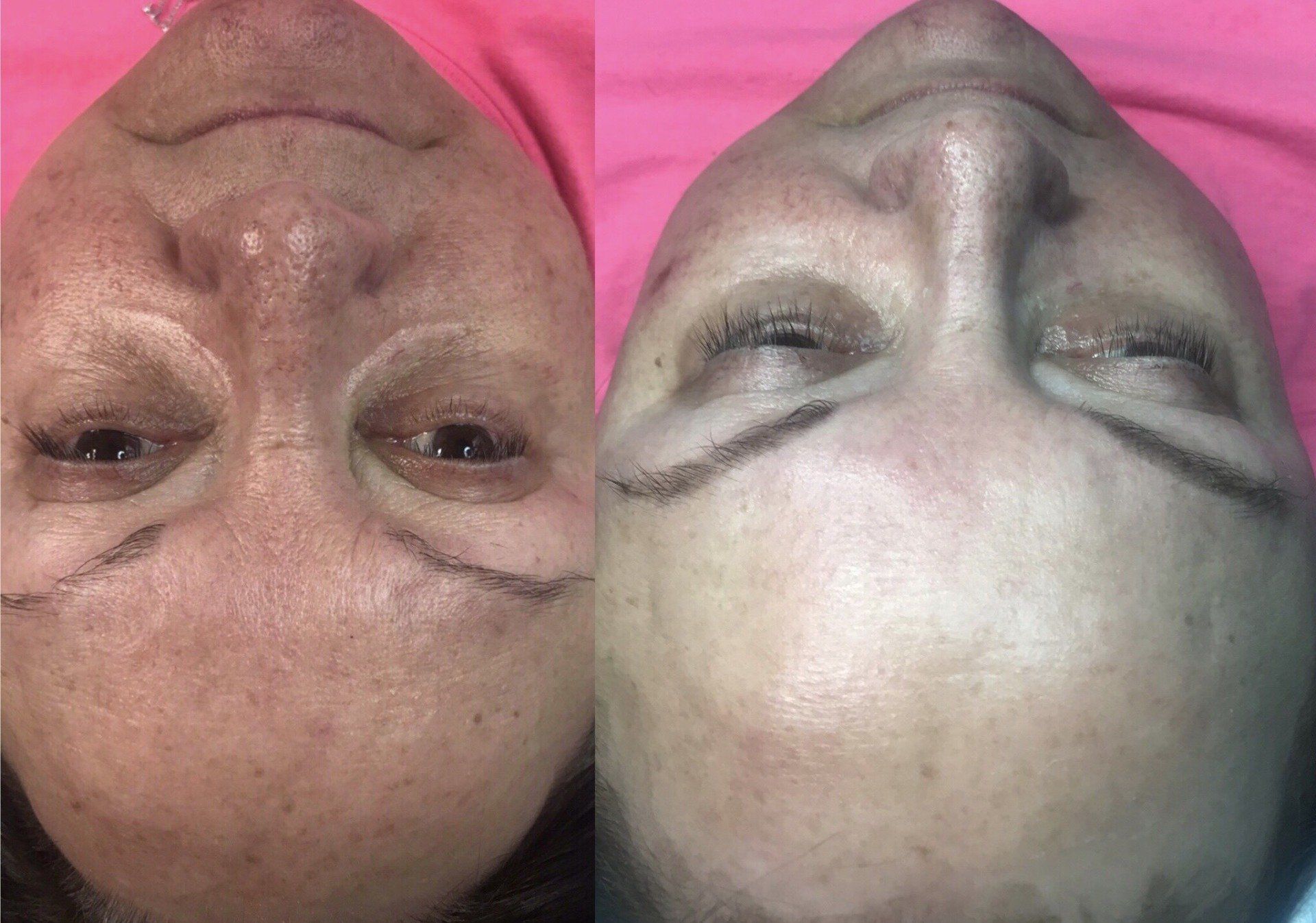 microneedling