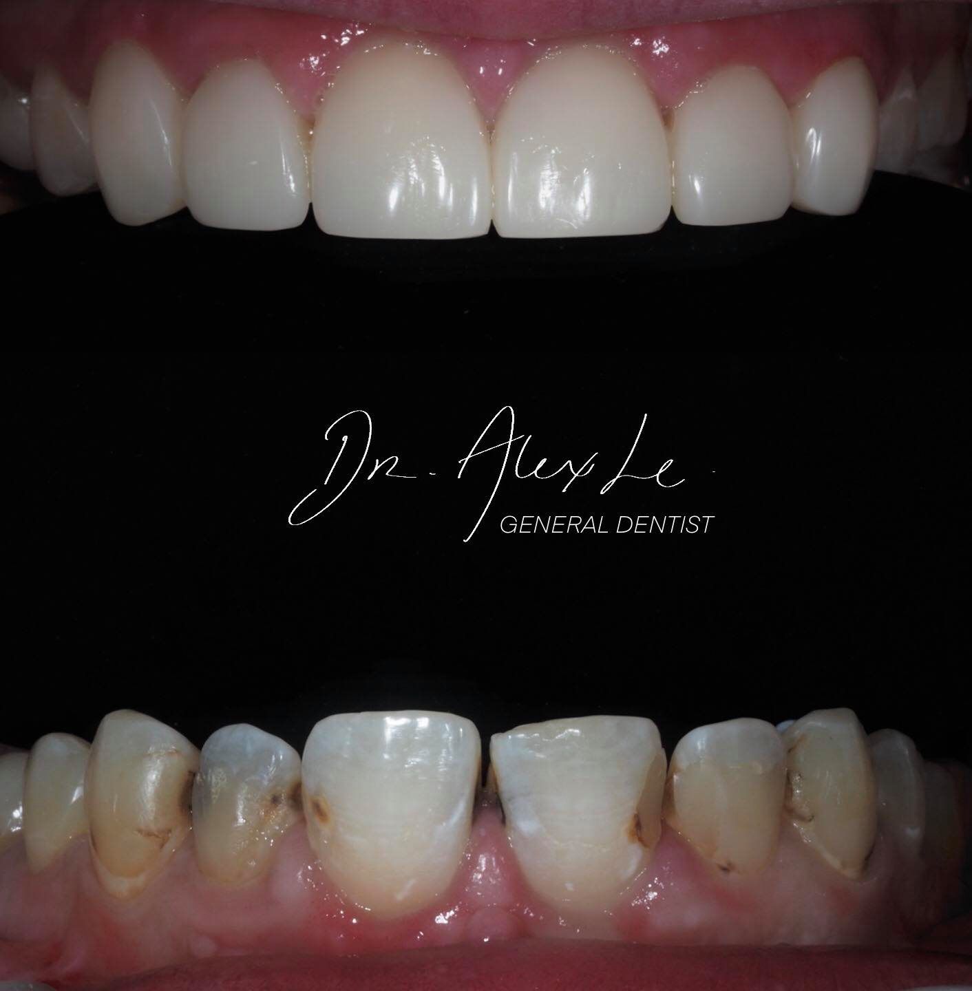 alex veneers