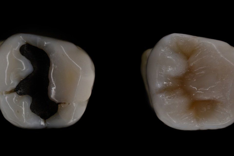 Crooked Teeth/Chipped Teeth