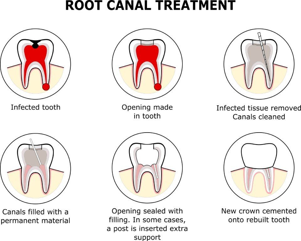 root canal treatment