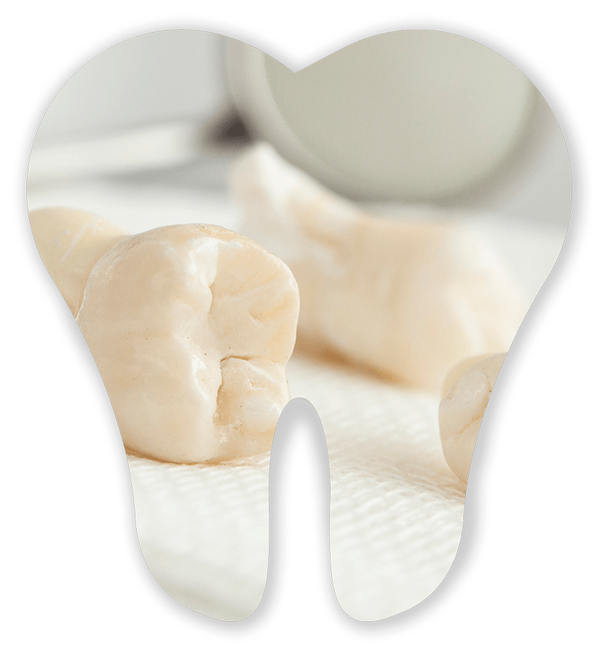 Wisdom Teeth Extraction — Germantown, TN — Mark A. Skidmore, DDS