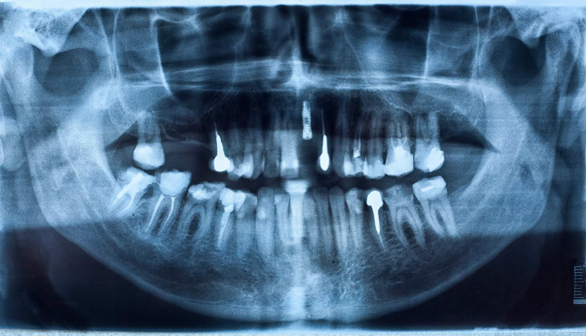 radiografia dentale