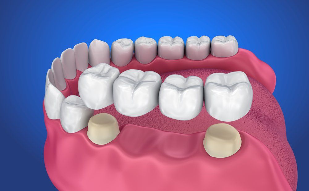 3D dental model showing upper and lower teeth with two molar implants in pink gums