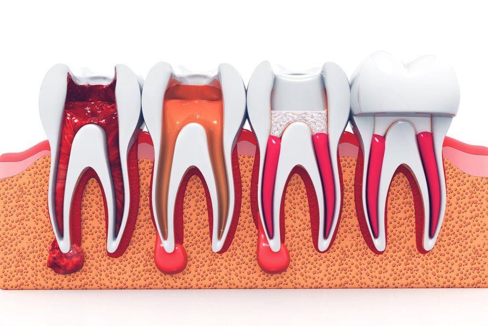 Cross-section of damaged teeth with exposed roots and inflamed gums, showing progression of tooth decay