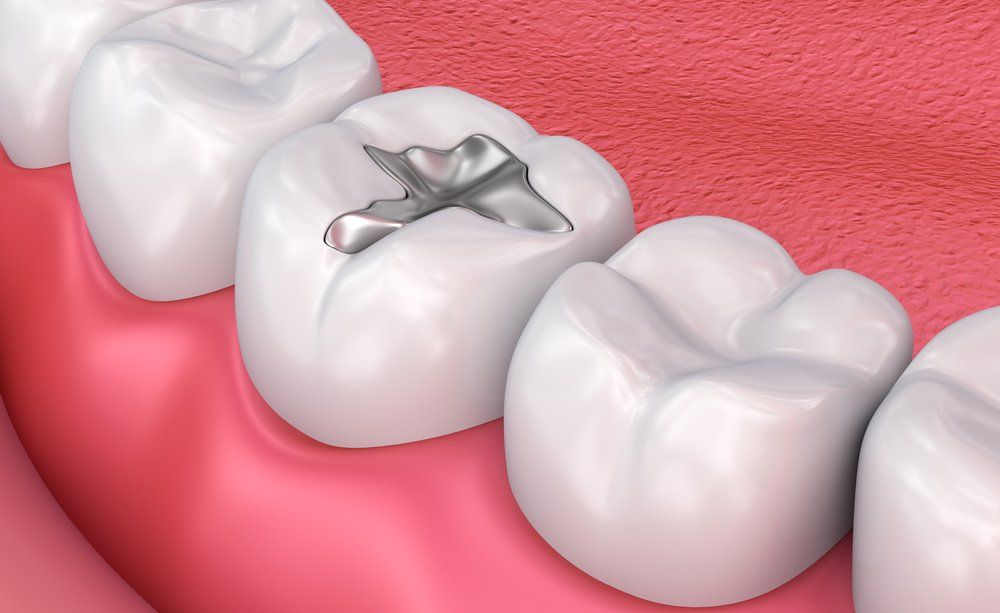 Close-up of molars with a silver dental filling on one tooth.