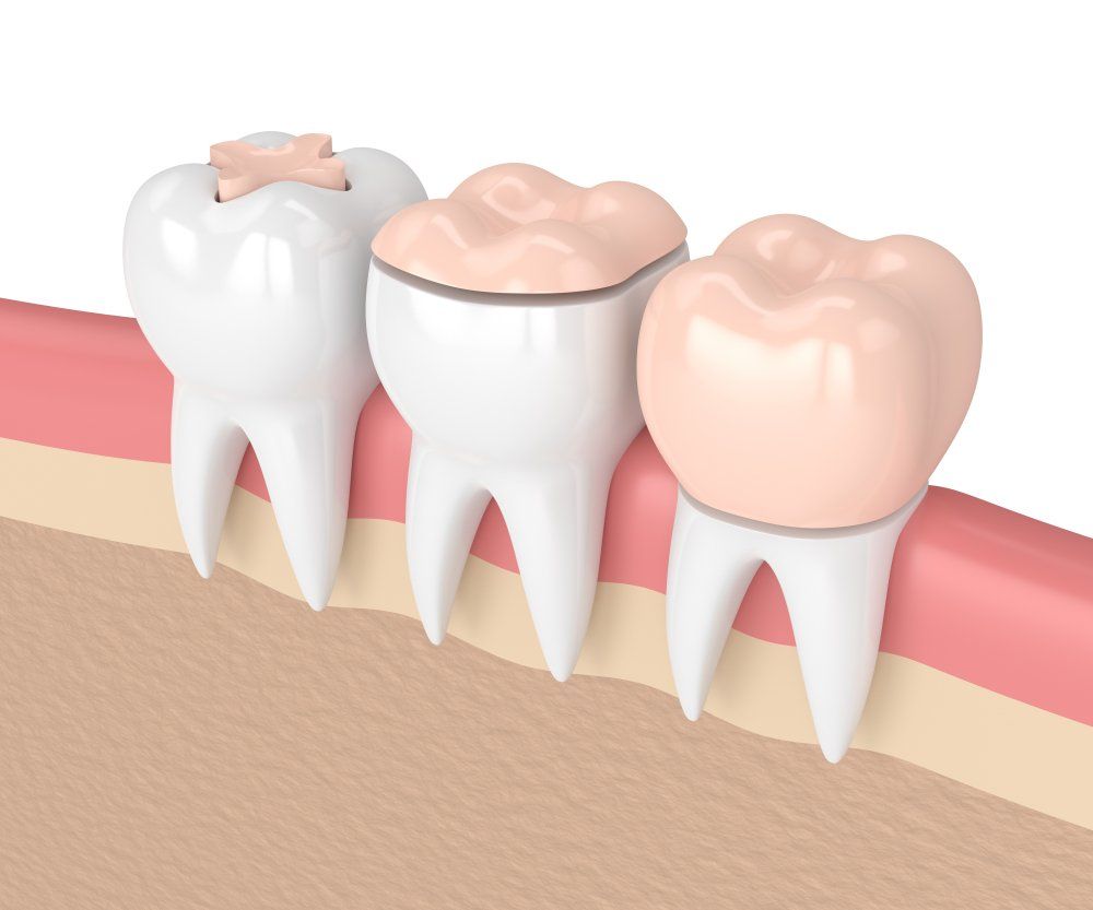 Three teeth in gum cross-section, showing a cavity on the left molar and fillings on the center and right teeth