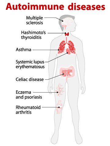 Natural Remedies for Autoimmune Disorders