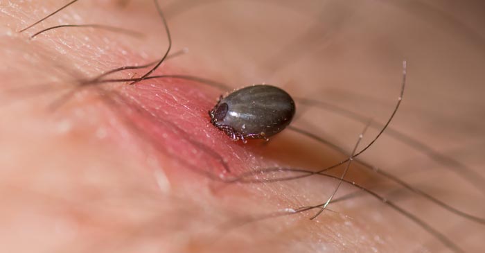 Lyme Disease Remedies - Dr. Louis Granirer Holistic Chiropractor Natural Remedies for Lyme Disease in Kingston Ulster County NY 12401