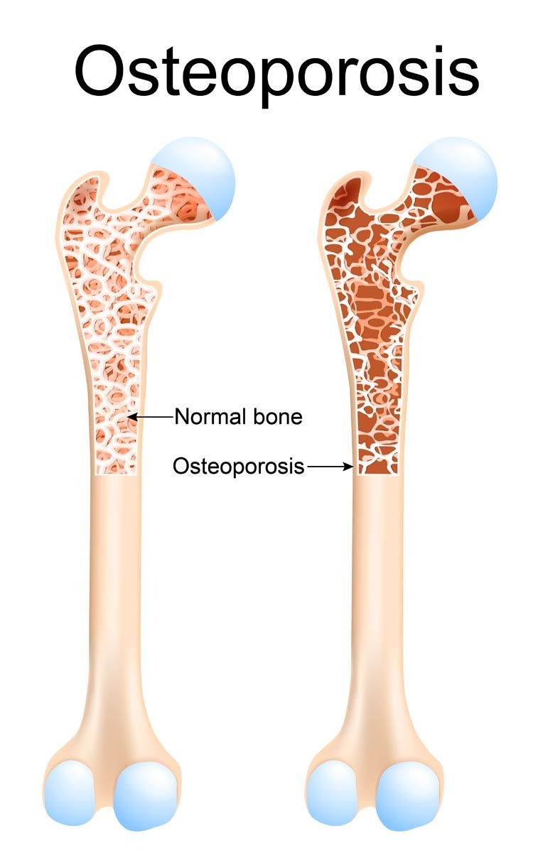 Click to enlarge and see the beginning and advanced stages of Osteoporosis Natural Remedy for Osteoporosis in Kingston, Ulster County NY 12401
