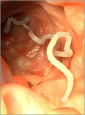 Parasite Cleansing - Dr. Louis Granirer Holistic Chiropractor. Remedy for Parasites in Kingston Ulster County NY 12401