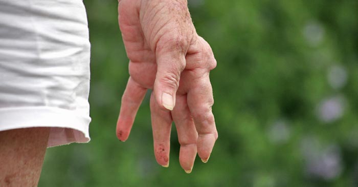 Rheumatoid Arthritis Remedies - Dr. Louis Granirer Holistic Chiropractor Rheumatoid Arthritis Remedy in Kingston Ulster County NY 12401