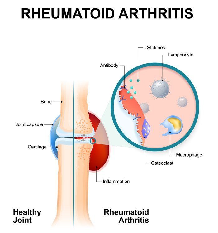 Click to Enlarge Rheumatoid Arthritis Remedy in Kingston NY from Dr. Louis Granirer Holistic Chiropractor