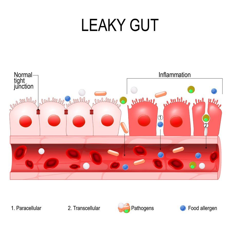 Click to Enlarge What is Leaky Gut Syndrome? Find Your Leaky Gut Syndrome Remedy at the Holistic Chiropractic Center in Kingston, Ulster County NY 12401