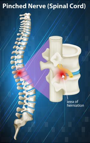Pinched Nerve Treatments NY - Dr. Louis Granirer Holistic Chiropractor