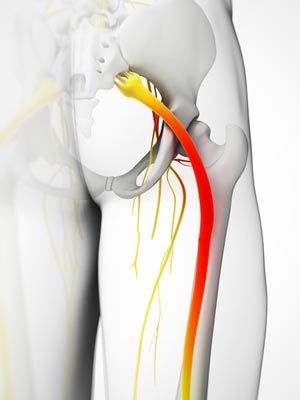 Treatment for Sciatica in Kingston Ulster County NY