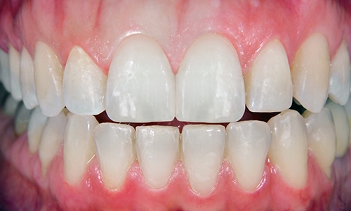 A close up of a person 's teeth with white teeth.