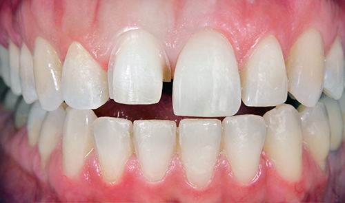 A close up of a person 's teeth with white teeth.