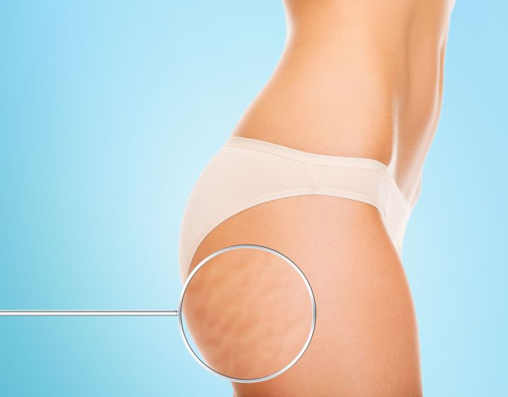 figura degli inestetismi della cellulite