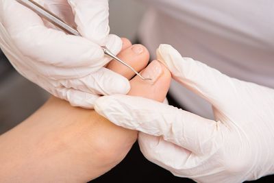 Trattamento podologico a Rivolta D'Adda