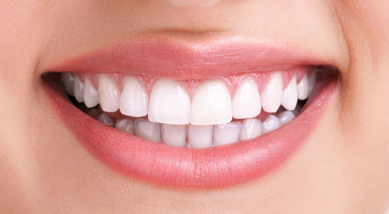 after teeth whitening