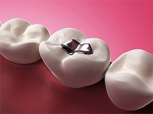 Silver Tooth Filling - Dentist in Mansfield, OH