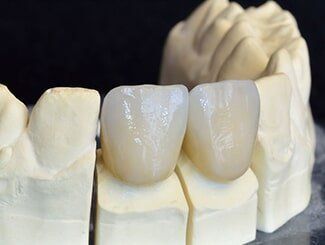 Dental Crown - Dentist in Mansfield, OH