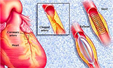 Coronary Stenting — St. Clair Shores, MI — Eastlake Cardiovascular, P.C.