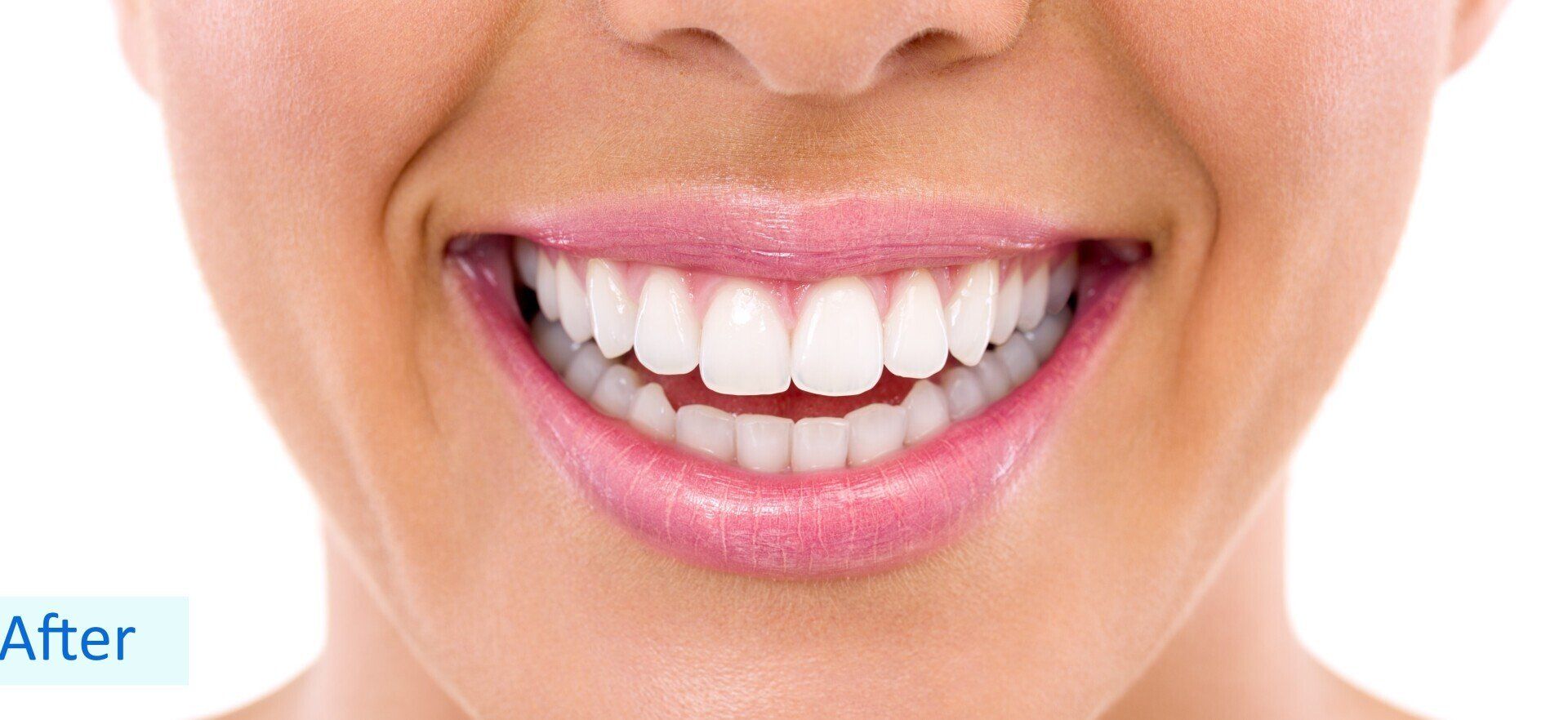 sbiancamento denti - dopo