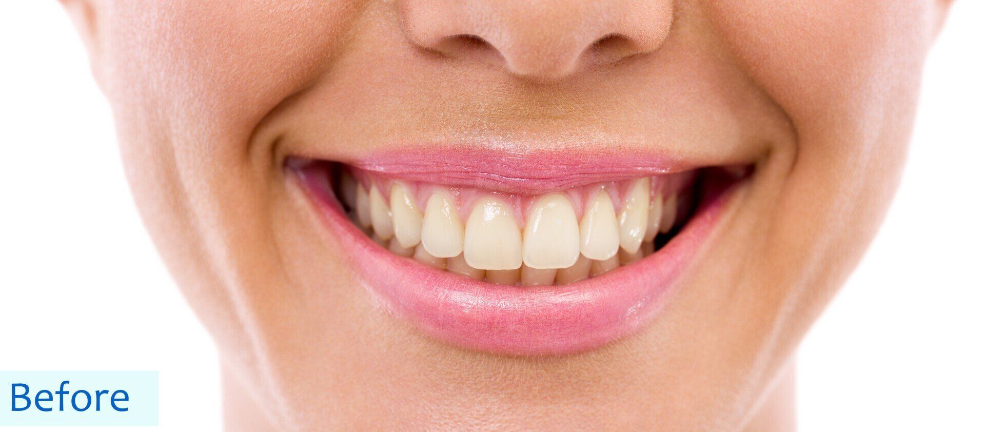 sbiancamento denti - prima