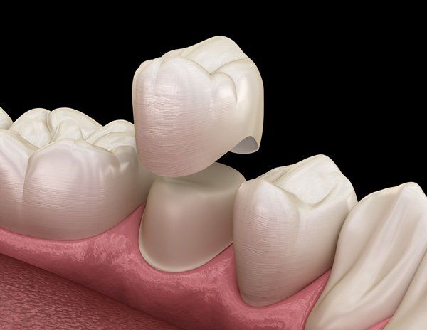 Zirconia crowns last 10-15 years - Best dentist in Lawrence KS Image of dental crown getting placed on a tooth - dental crowns from top rated family dentist in Lawrence KS 66049