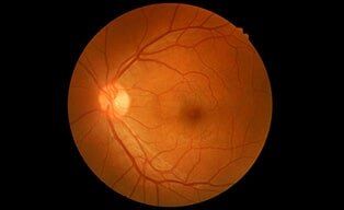 Eye — retina disease treatment in Syracuse, NY Eye — retina disease treatment in Syracuse, NY