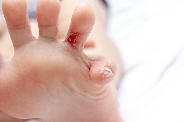Fungal infection treatment
