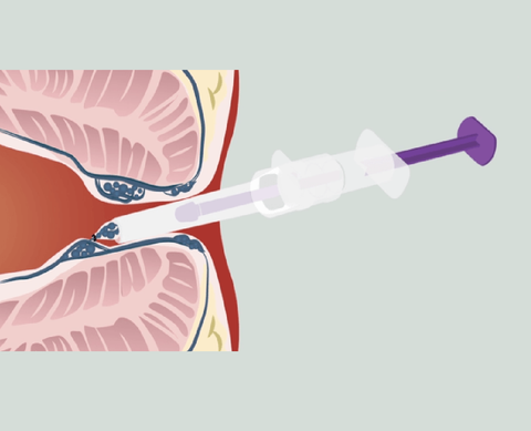 Cross-section of ear with syringe injecting medicine into the eardrum; purple plunger, white syringe.