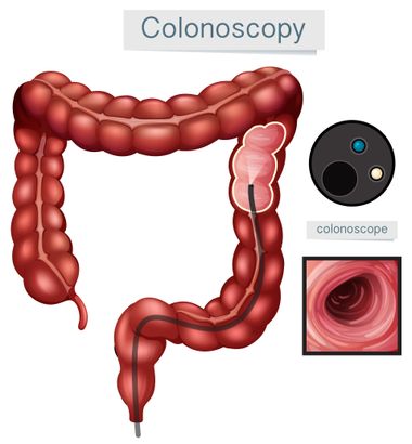 Colonoscopy diagram: A medical illustration showing a colon and a colonoscope inside, with a polyp highlighted.