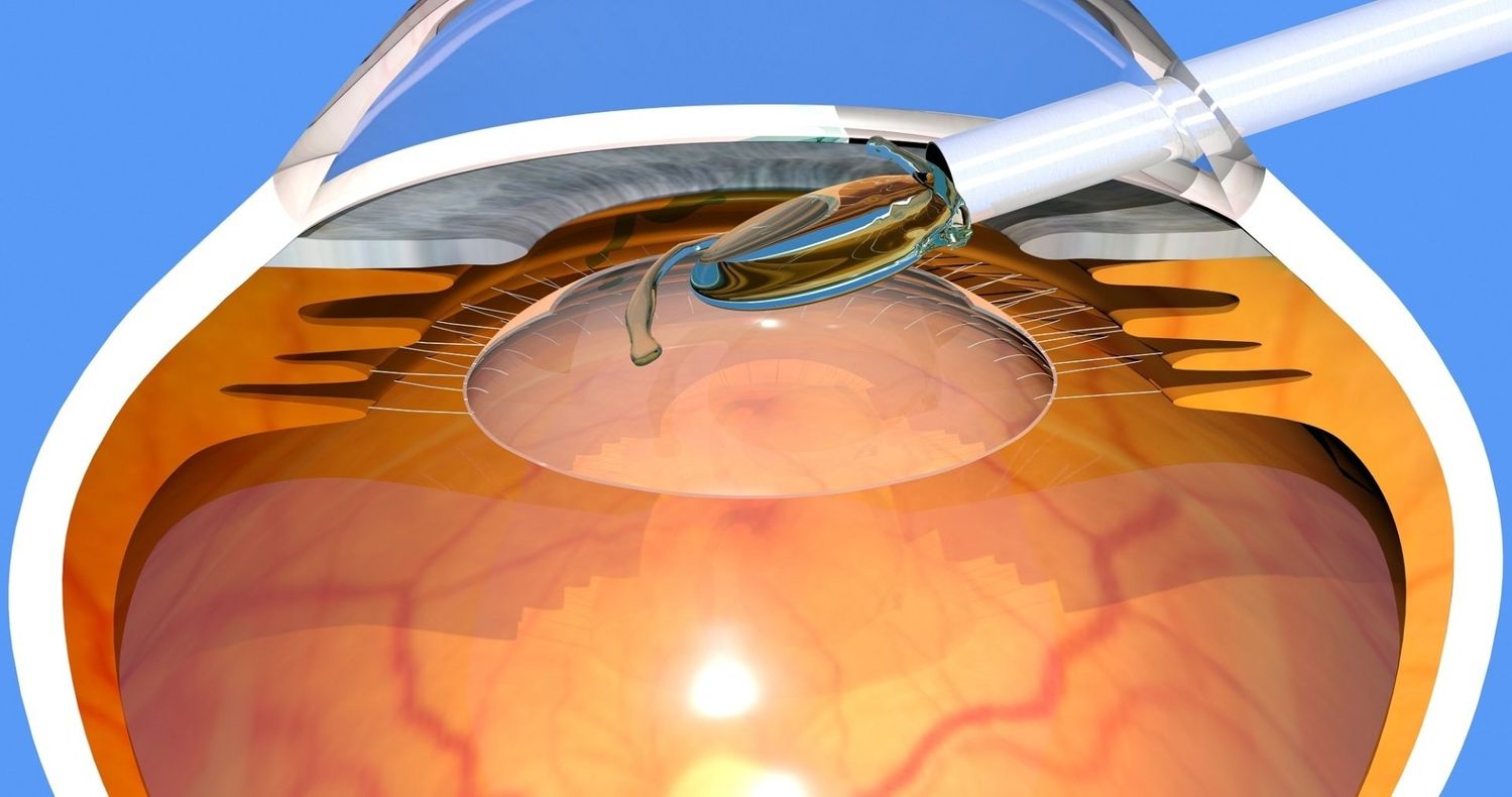 Impianto lenti intraoculari (ICL)