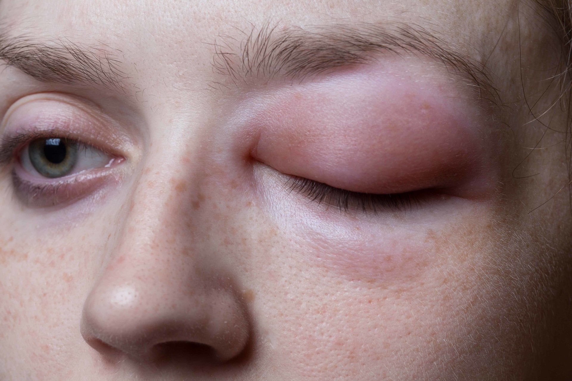 person with a swollen eye