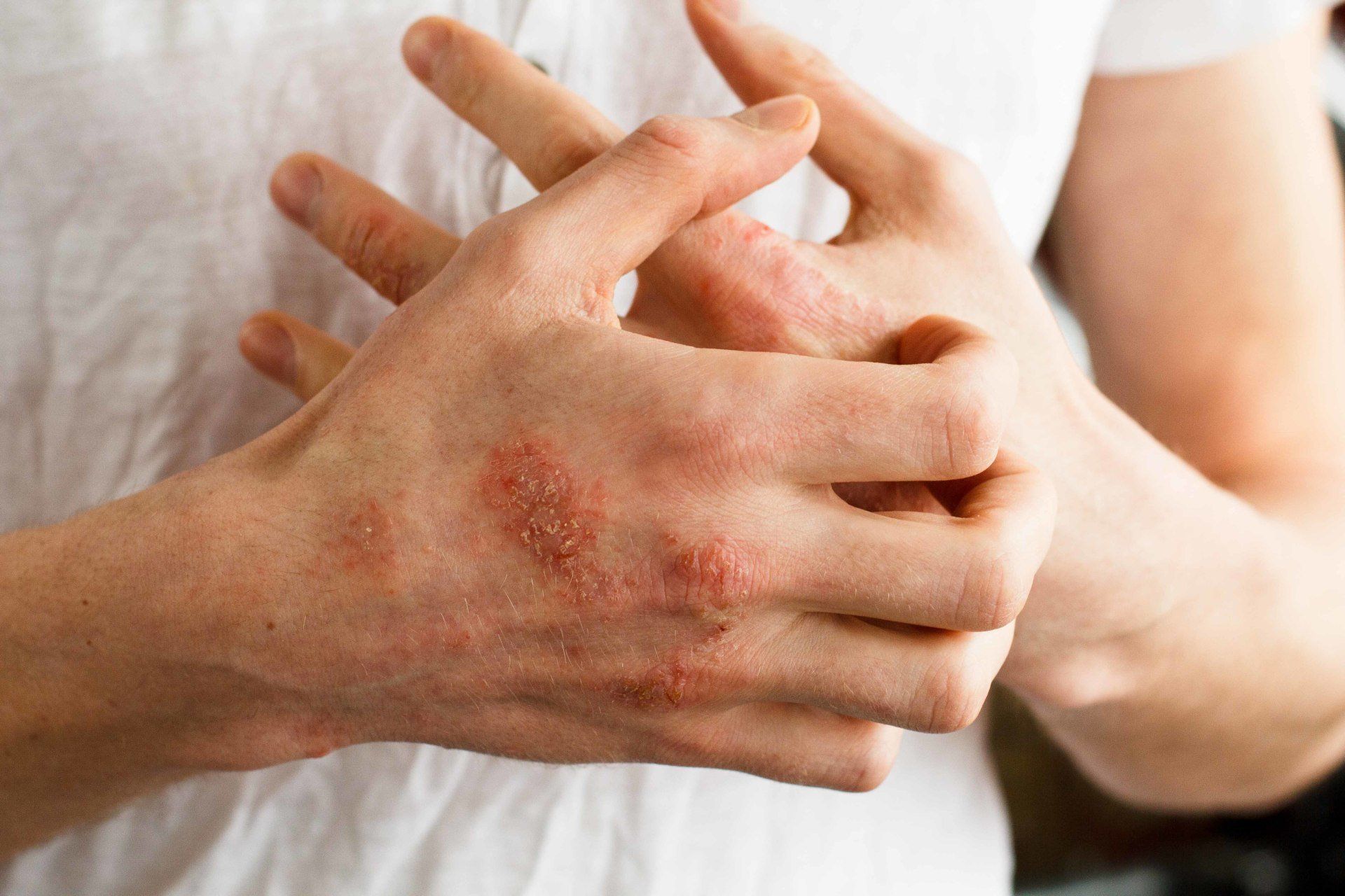 two hands with hives
