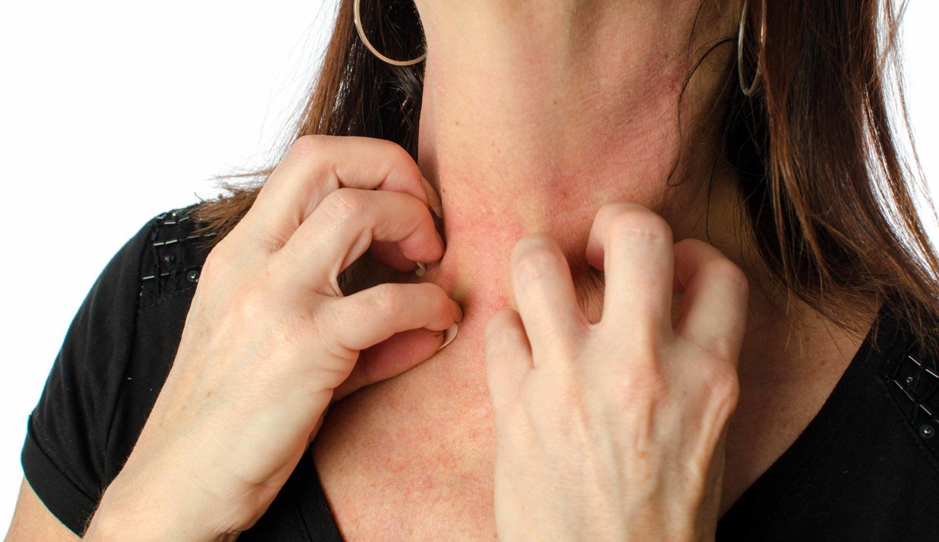woman scratching eczema