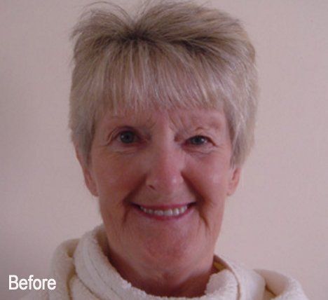 An older woman is smiling in a before photo