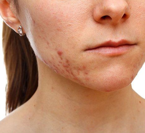 Derma Rolling by Jennie Chews Essence of Healing in Grays, Thurrock