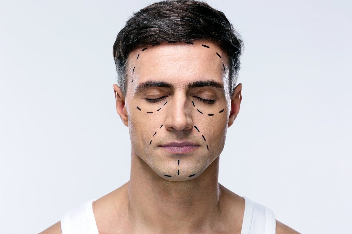 A man has lines drawn on his face waiting for non-invasive facelift