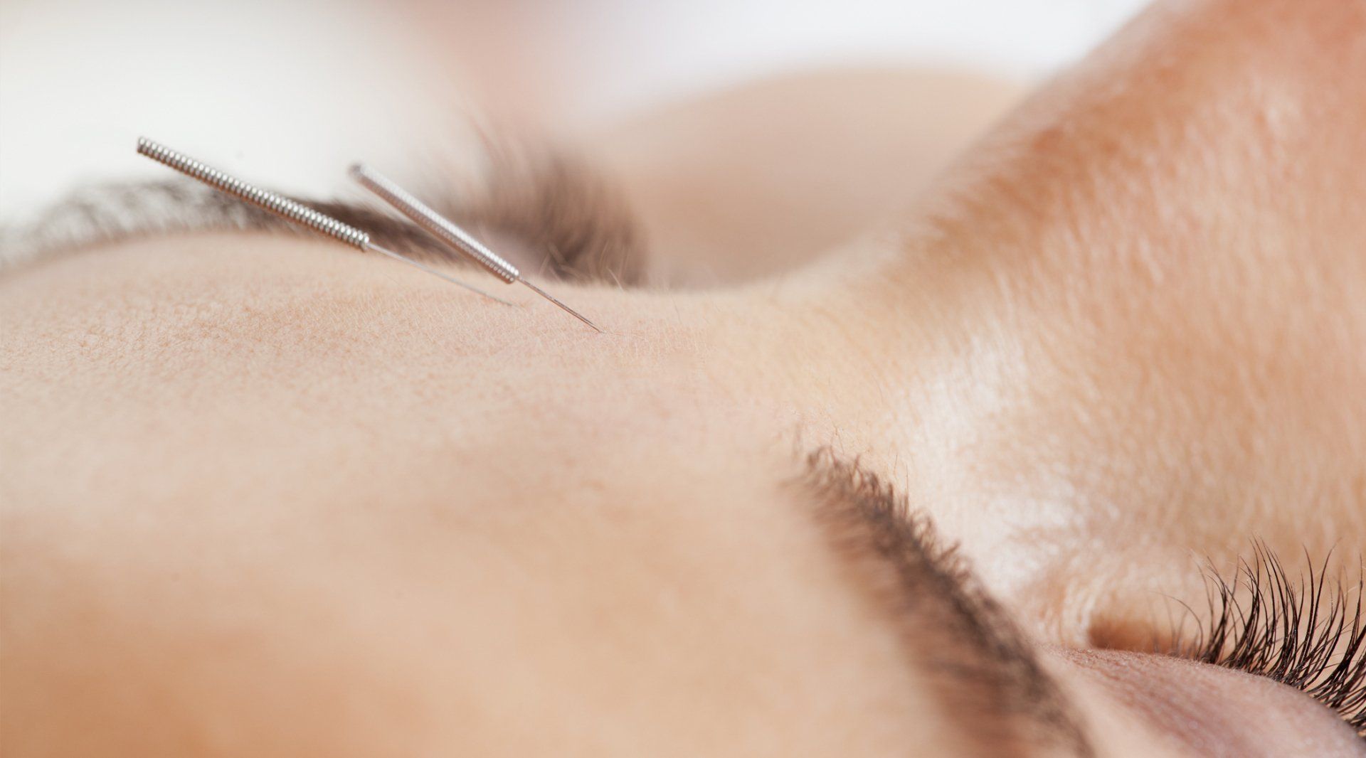 acupuncture facelift non-invasive by Jennie Chew Essence of Healing in Grays, Thurrock