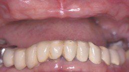 upper/lower arch rehabilitation before